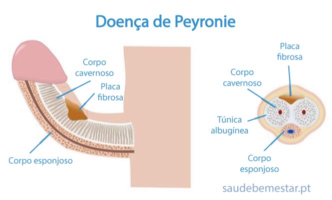 doença de peyronie